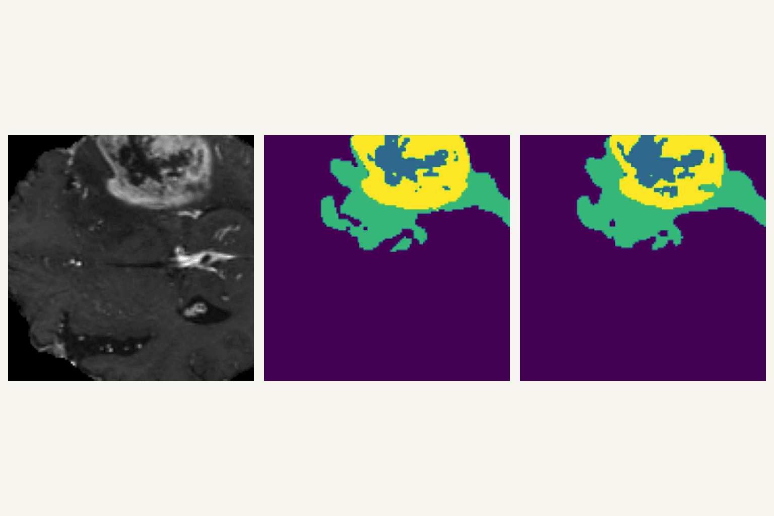 An axial brain MRI slice from the BraTS 2020 dataset beside its ground-truth tumour label and the 3D U-Net's predicted segmentation, with tumour sub-regions in different colours.